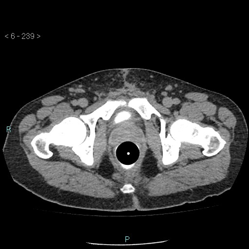 Colo-cutaneous fistula (Radiopaedia 40531-43129 A 100).jpg