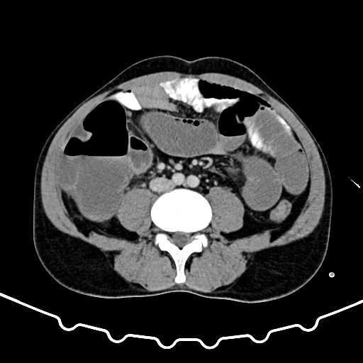 Colocolic intussusception due to large lipoma (Radiopaedia 68773-78482 A 114).jpg