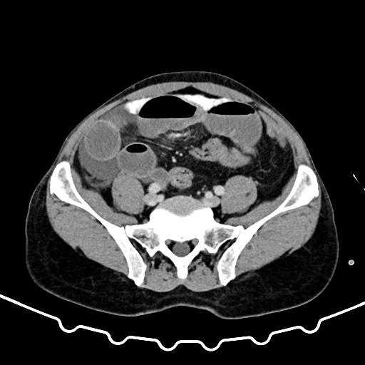 Colocolic intussusception due to large lipoma (Radiopaedia 68773-78482 A 138).jpg