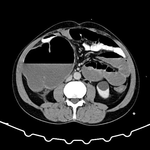 Colocolic intussusception due to large lipoma (Radiopaedia 68773-78482 A 95).jpg