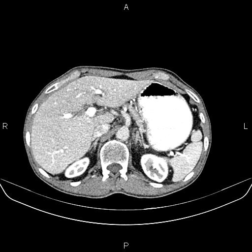 Colon adenocarcinoma - hepatic flexure (Radiopaedia 85635-101395 A 23).jpg