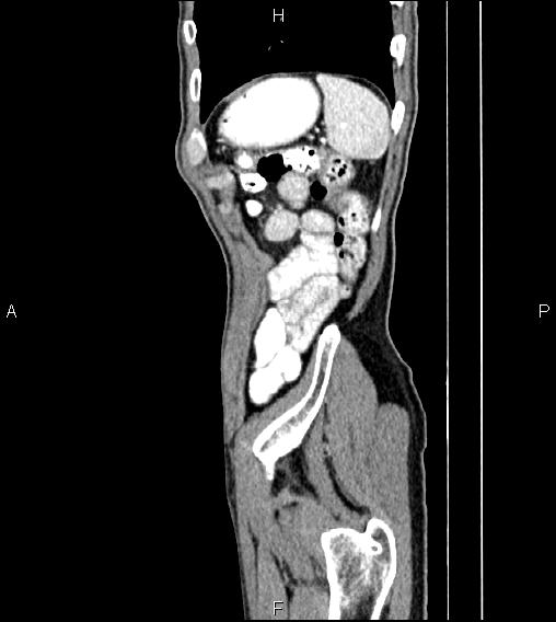 Colon adenocarcinoma - hepatic flexure (Radiopaedia 85635-101395 D 80).jpg