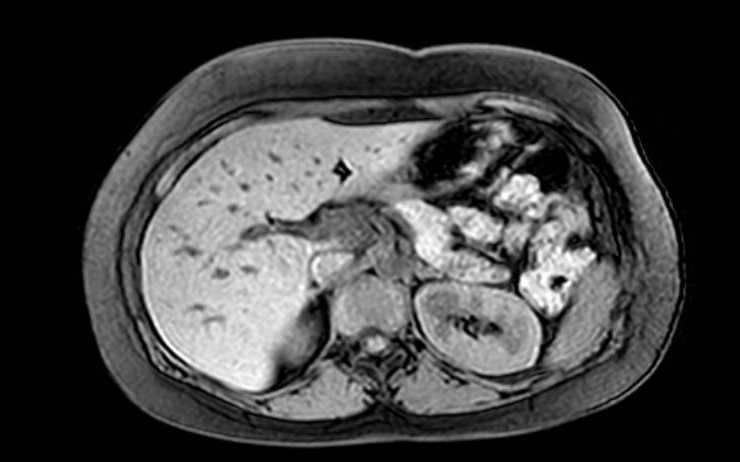 Colon adenocarcinoma with Krukenberg tumors, advanced pregnancy (Radiopaedia 67279-76645 A 61).jpg