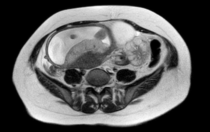 File:Colon adenocarcinoma with Krukenberg tumors, advanced pregnancy (Radiopaedia 67279-76645 Axial T2 29).jpg