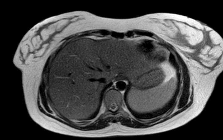 Colon adenocarcinoma with Krukenberg tumors, advanced pregnancy (Radiopaedia 67279-76645 Axial T2 75).jpg