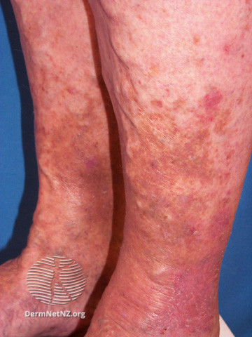 File:Gravitational dermatitis (DermNet NZ site-age-specific-lowerleg4).jpg