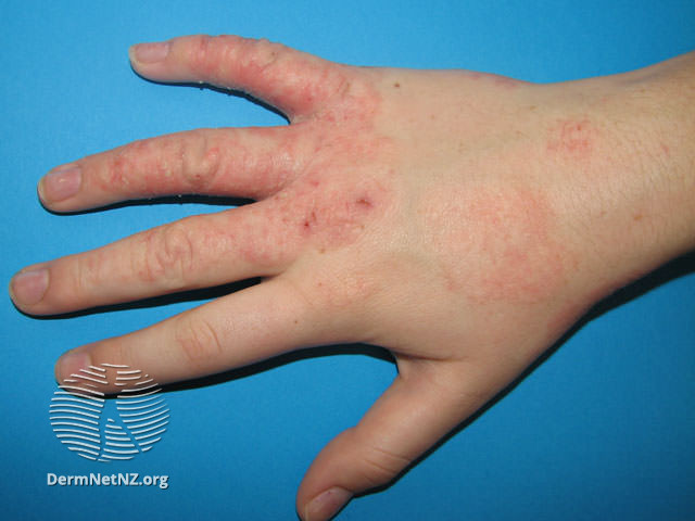 File:Hand eczema (DermNet NZ dermatitis-atopic34).jpg