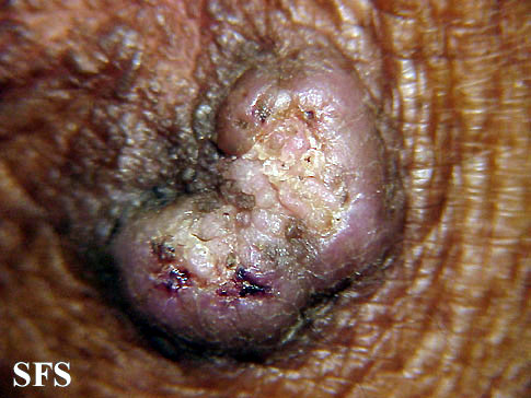 File:Keratoacanthoma (Dermatology Atlas 34).jpg