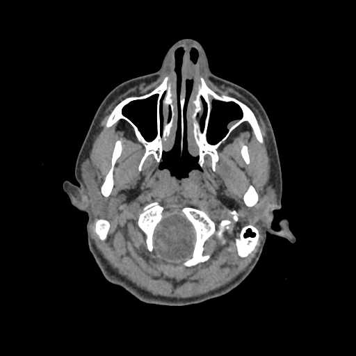 Nasal pyogenic granuloma (lobular capillary hemangioma) (Radiopaedia 85536-101244 Axial non-contrast 31).jpg