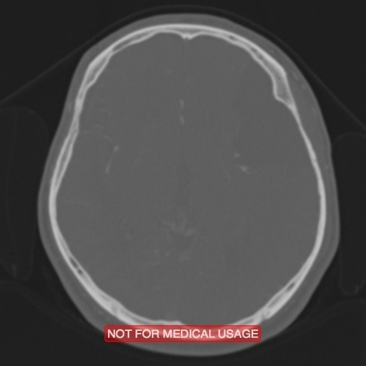 File:Nasopharyngeal carcinoma recurrence - skull base destruction (Radiopaedia 29107-29490 Axial bone window 54).jpg