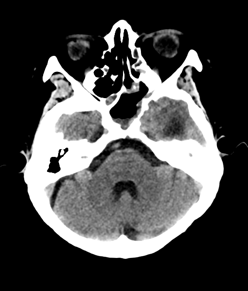File:Nasopharyngeal carcinoma with cerebral abscess (Radiopaedia 43018-46275 Axial non-contrast 16).png