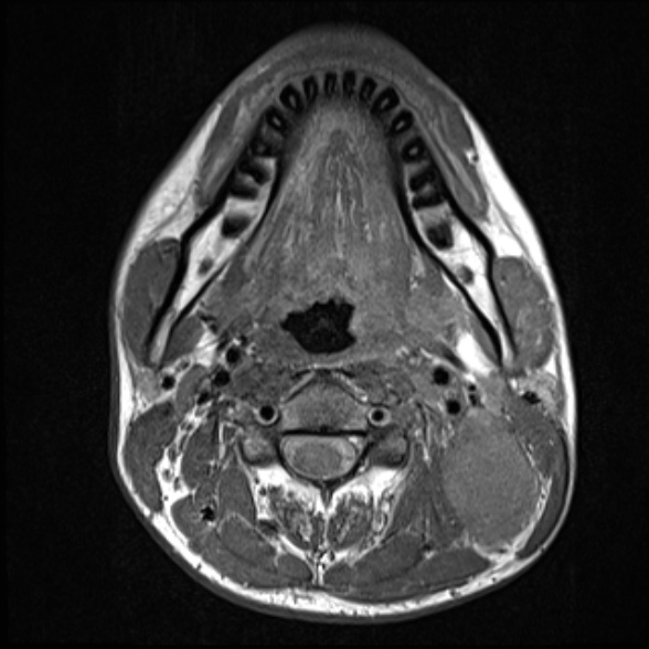 File:Nasopharyngeal carcinoma with skull base invasion (Radiopaedia 53415-59485 Axial T1 44).jpg