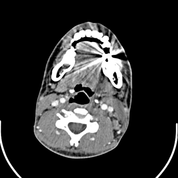 File:Nasopharyngeal carcinoma with skull base invasion (Radiopaedia 53415-59705 A 118).jpg