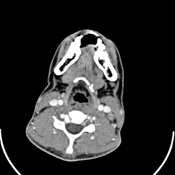 File:Nasopharyngeal carcinoma with skull base invasion (Radiopaedia 53415-59705 A 132).jpg