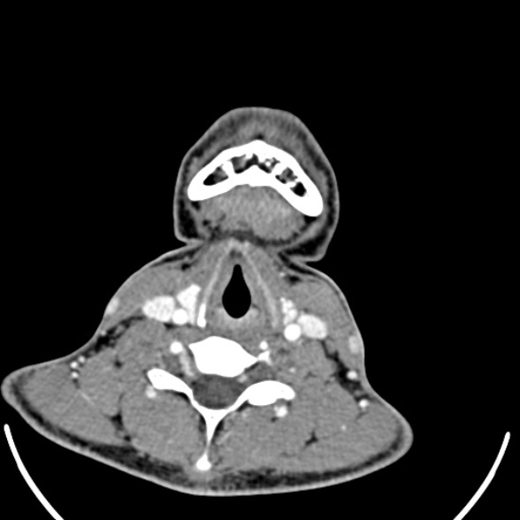 Nasopharyngeal carcinoma with skull base invasion (Radiopaedia 53415-59705 A 151).jpg