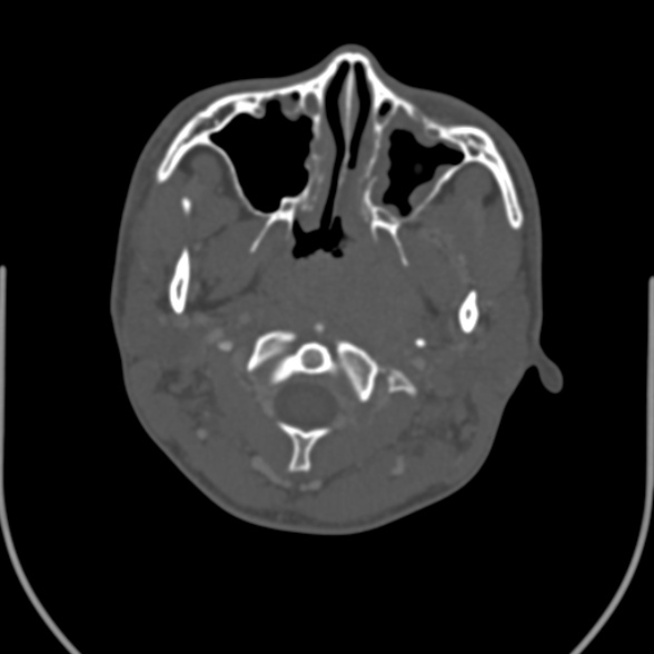 Nasopharyngeal carcinoma with skull base invasion (Radiopaedia 53415-59705 Axial bone window 53).jpg