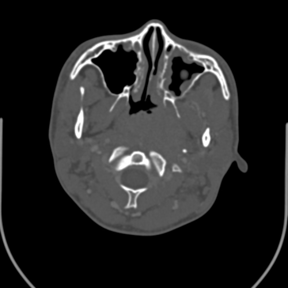 Nasopharyngeal carcinoma with skull base invasion (Radiopaedia 53415-59705 Axial bone window 54).jpg