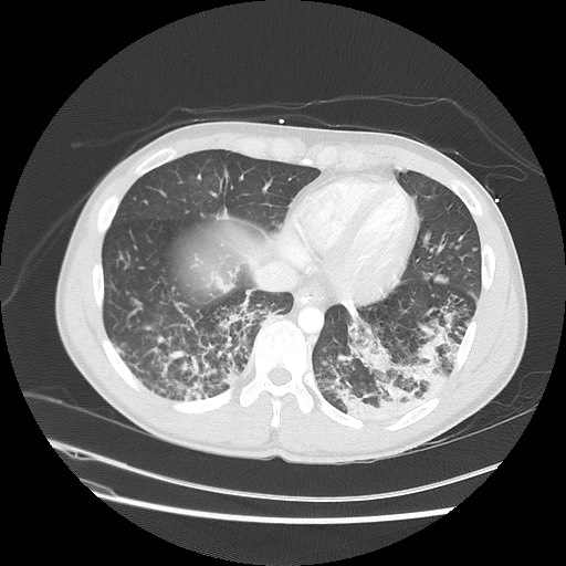 Near-drowning pulmonary edema (Radiopaedia 59457-66814 Axial lung window 44).jpg
