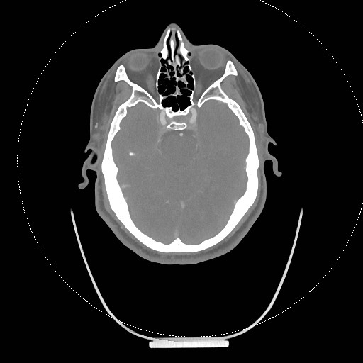 Neck CT angiogram (intraosseous vascular access) (Radiopaedia 55481-61945 B 286).jpg