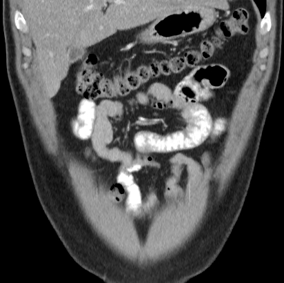 File:Necrotizing pancreatitis with acute necrotic collection (Radiopaedia 14470-14417 C 4).jpg