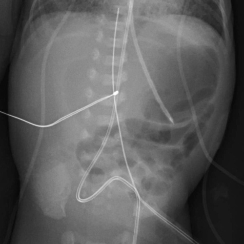 File:Neonatal bowel perforation (Radiopaedia 23839-23999 Frontal 1).jpg