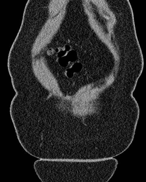 File:Nephrostomy for urosepsis (Radiopaedia 26180-26330 non-contrast 13).jpg