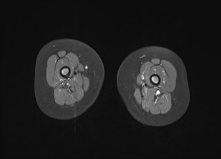 File:Neuroblastoma with bone metastases (Radiopaedia 67080-76414 Axial T1 C+ fat sat 25).jpg