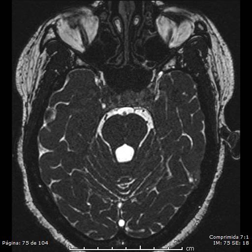 Neurocysticercosis (Radiopaedia 58636-65832 I 75).jpg