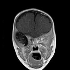File:Neurofibromatosis type 1 (Radiopaedia 30089-30671 Coronal T1 C+ 8).jpg