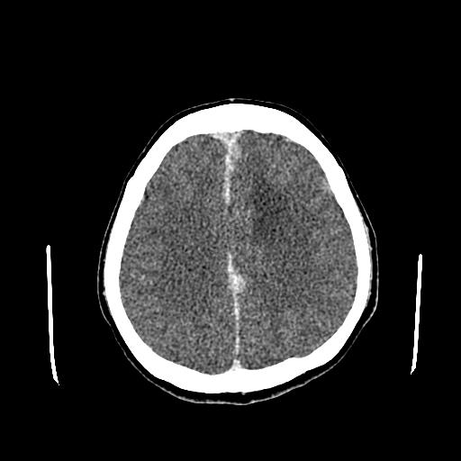 File:Neurofibromatosis type 2 (Radiopaedia 25389-25637 Axial C+ 69).jpg