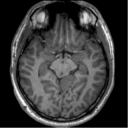 File:Neurofibromatosis type 2 (Radiopaedia 44936-48838 Axial T1 58).png