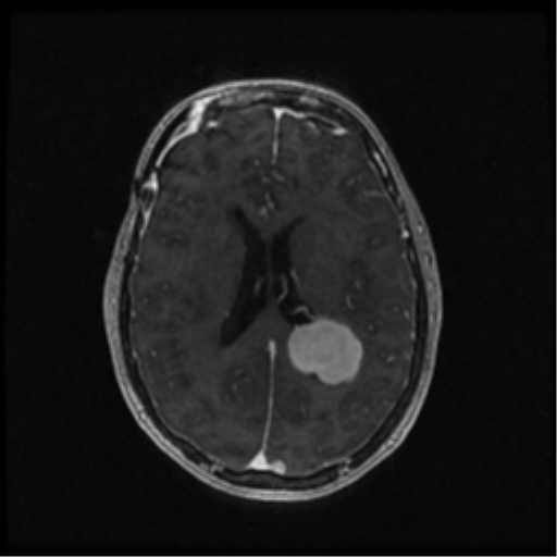 Neurofibromatosis type 2 (Radiopaedia 45229-49244 Axial T1 C+ 74).png