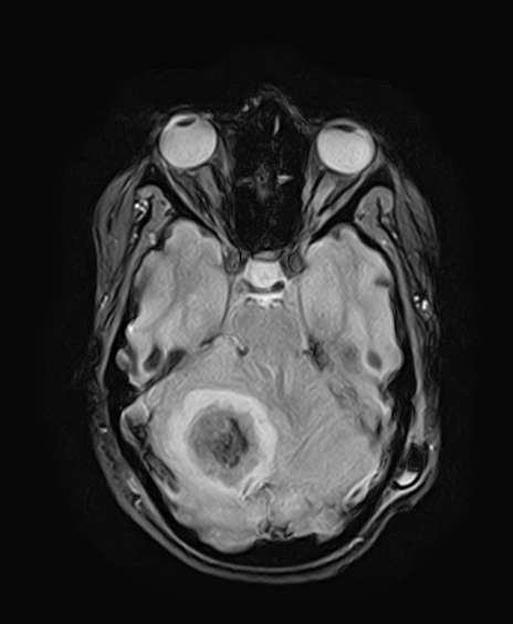 File:Neurofibromatosis type 2 (Radiopaedia 66211-75401 Axial Gradient Echo 12).jpg
