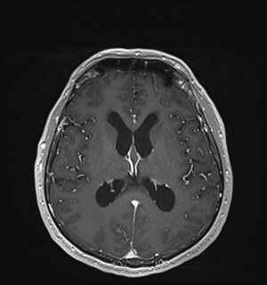 Neurofibromatosis type 2 (Radiopaedia 79097-92049 Axial T1 C+ 112).jpg
