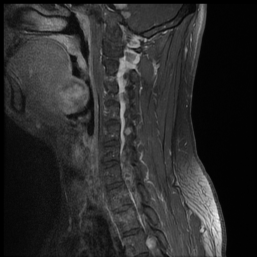 File:Neurofibromatosis type 2 (spinal manifestations) (Radiopaedia 53943-60070 G 9).png