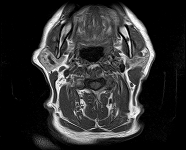File:Non-Hodgkin lymphoma - parotid gland (Radiopaedia 71531-81890 Axial T1 9).jpg