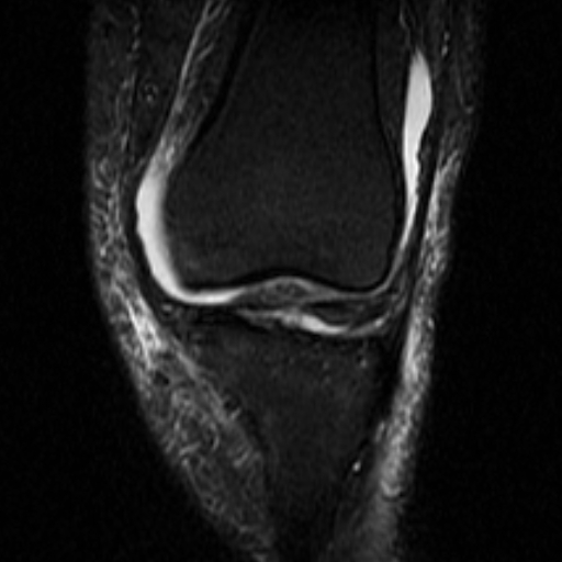 File:Non-displaced patella fracture (Radiopaedia 15932-15582 Coronal STIR 9).jpg