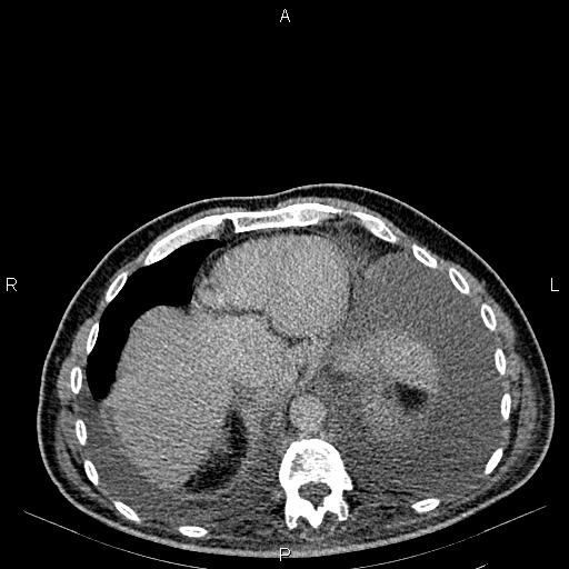 Non Hodgkin lymphoma in a patient with ankylosing spondylitis (Radiopaedia 84323-99621 Axial C+ delayed 8).jpg