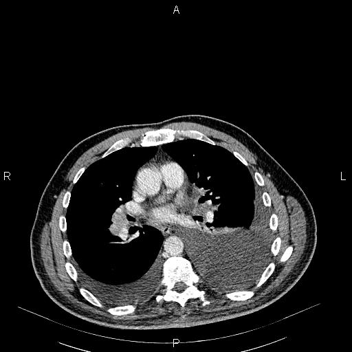 File:Non Hodgkin lymphoma in a patient with ankylosing spondylitis (Radiopaedia 84323-99621 B 18).jpg