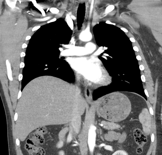 File:Normal CTA thorax (non ECG gated) (Radiopaedia 41750-44704 B 47).png