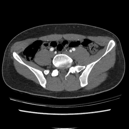 File:Normal CT angiogram of pelvis (Radiopaedia 45390-49430 A 24).jpg