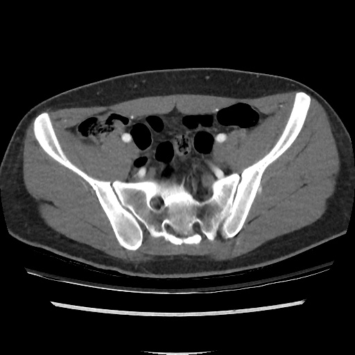 File:Normal CT angiogram of pelvis (Radiopaedia 45390-49430 A 31).jpg