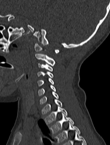 File:Normal CT cervical spine - pediatric (Radiopaedia 52549-58462 Sagittal bone window 59).jpg
