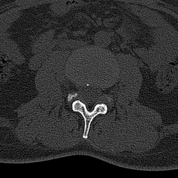 File:Normal CT lumbar spine (Radiopaedia 53981-60118 Axial bone window 40).jpg