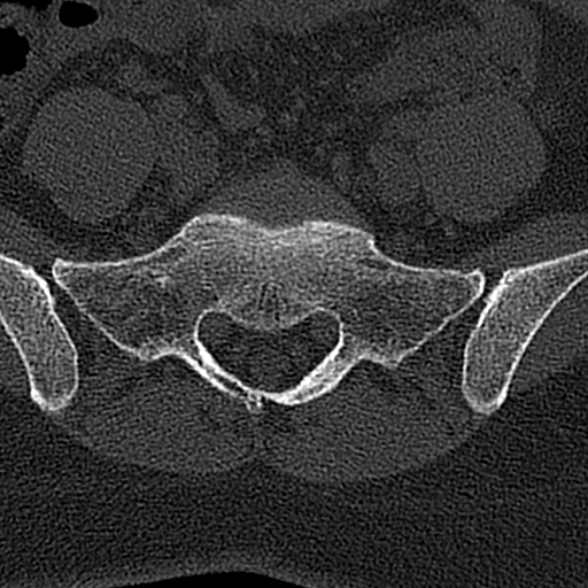 File:Normal CT lumbar spine (Radiopaedia 53981-60118 Axial bone window 67).jpg