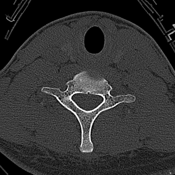 Normal CT of the cervical spine (Radiopaedia 53322-59305 Axial bone window 203).jpg