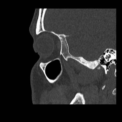 Normal CT paranasal sinuses (Radiopaedia 42286-45390 Sagittal bone window 16).jpg
