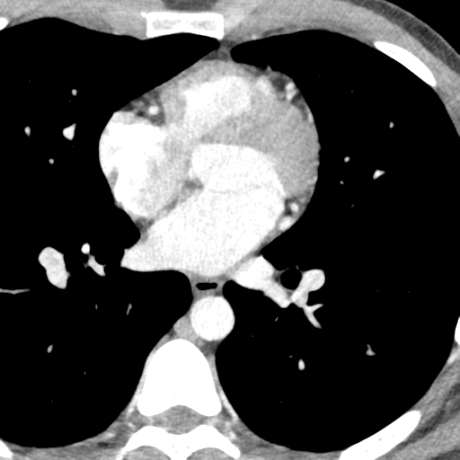 File:Normal CT pulmonary veins (pre RF ablation) (Radiopaedia 41748-44702 A 172).png