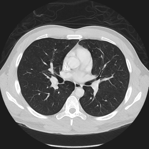 Normal CT pulmonary veins (pre RF ablation) (Radiopaedia 41748-44702 Axial lung window 19).png