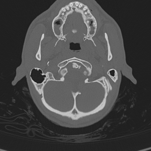 Normal CT skull (Radiopaedia 40798-43459 A 15).png